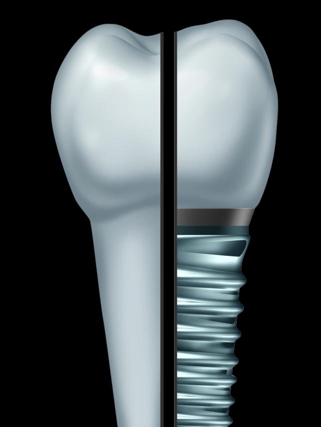 What is a  Dental Implant? By Dr. Swati Khanna.