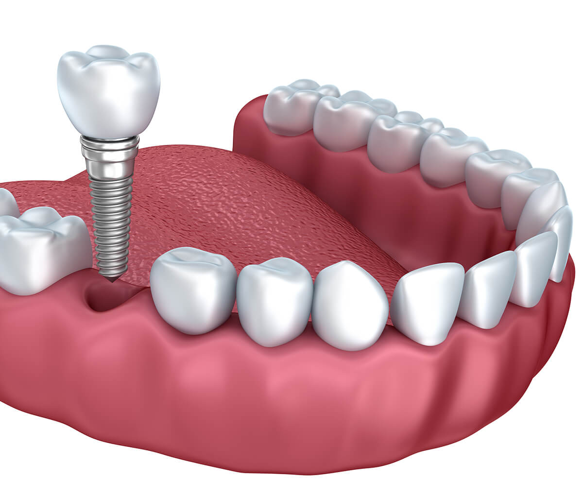 Care for Tooth Implants After Surgery in Burlington ON Area