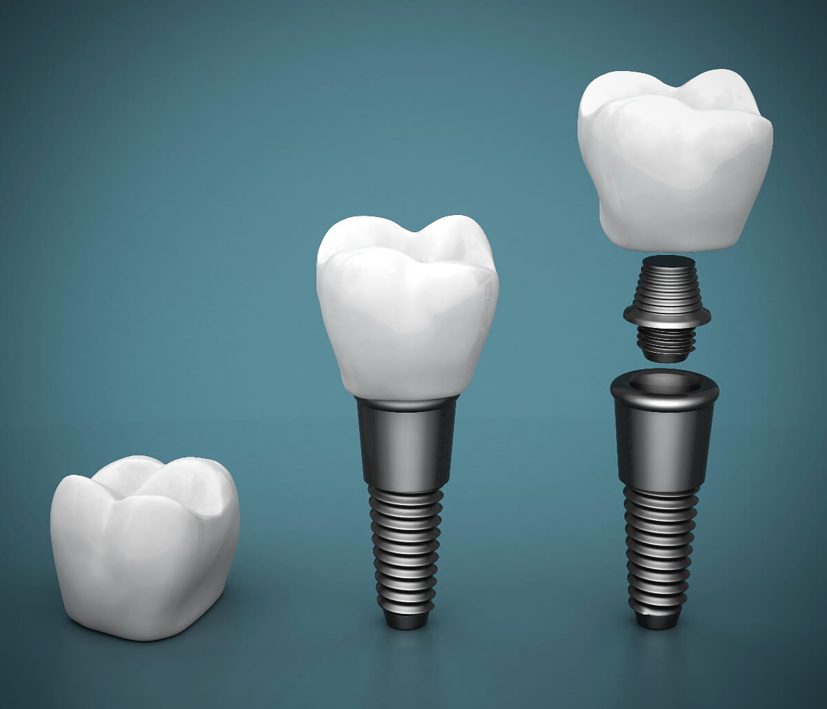 Dental Implants in Aldershot ON area