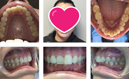 Invisalign Clear Braces in Burlington ON - Orthodontic Treatment